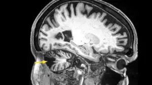 بهبود تعادل ۱۲ سال پس از سکته مغزی با تحریک مغناطیسی